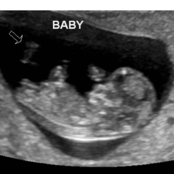 Carlissa Pierce - Day 2 - ultrasound image