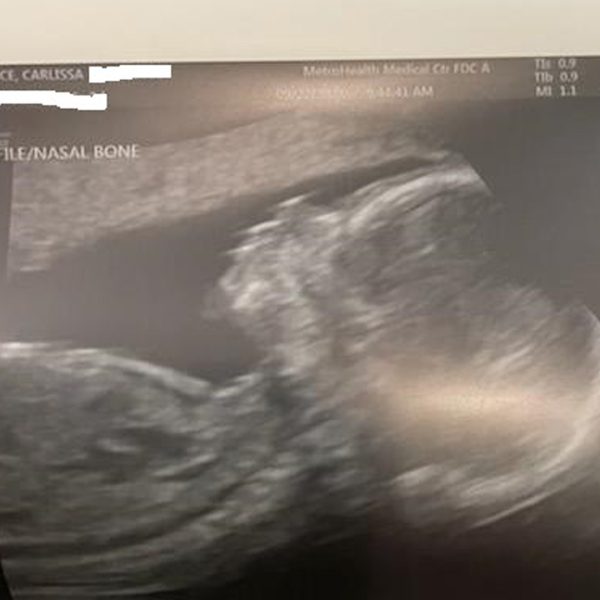 Carlissa Pierce - Day 2 - ultrasound photo