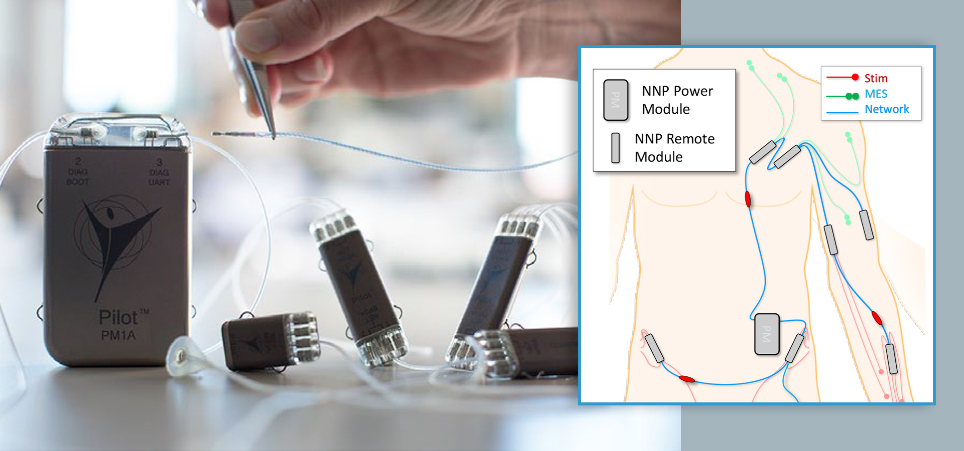 Three Decades, One Technology: Networked Neuroprosthesis
