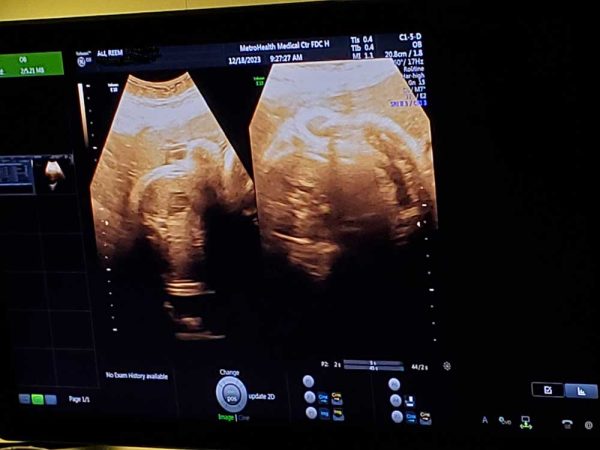 ultrasound of twins